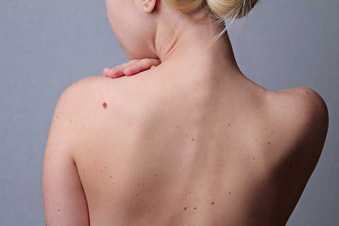Hautkrebsvorsorge-Bilquelle-Fotolia-Glisic-Albina